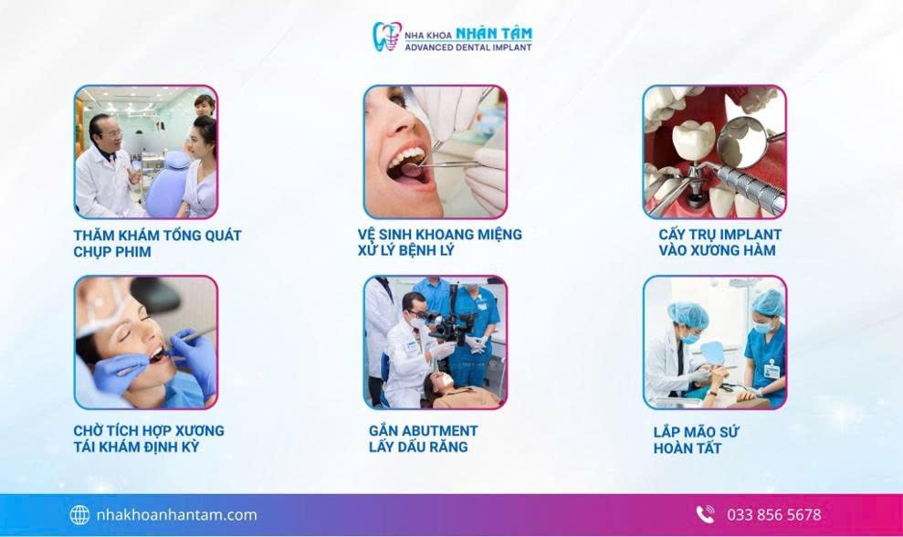 Quy trình trồng răng Implant chuẩn y khoa Quy trình trồng răng Implant chuẩn y khoa