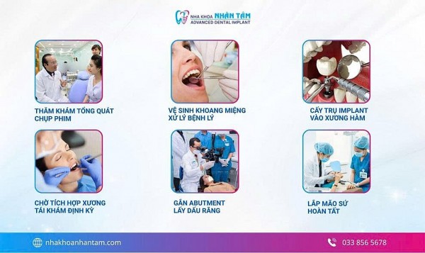 Quy trình trồng răng Implant chuẩn y khoa