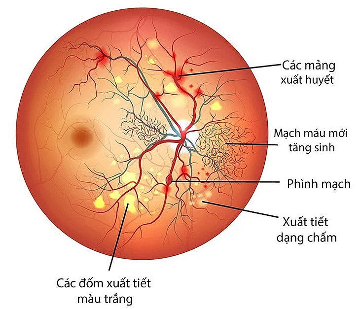 Người bệnh đái tháo đường cần chụp đáy mắt ít nhất 1 lần/năm