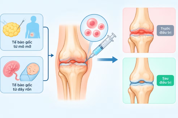 Cẩn trọng trong việc sử dụng tế bào gốc điều trị khớp gối Cẩn trọng trong việc sử dụng tế bào gốc điều trị khớp gối