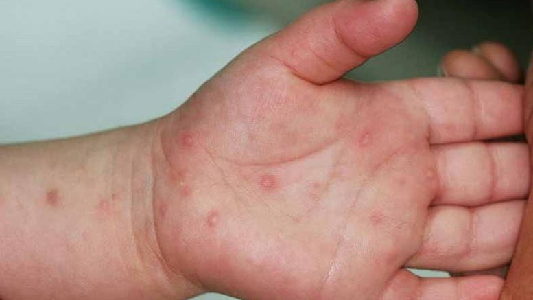 Ghi nhận 3.000 ca mắc tay chân miệng mỗi tuần, Bộ Y tế khuyến cáo khẩn