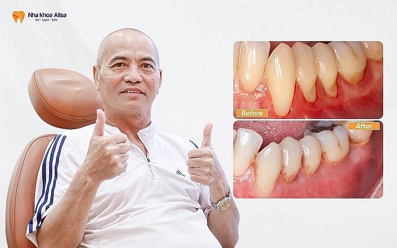 BS Nguyễn Văn Vững (Nha khoa Alisa): Theo đuổi giải pháp ưu tiên bảo tồn răng thật BS Nguyễn Văn Vững (Nha khoa Alisa): Theo đuổi giải pháp ưu tiên bảo tồn răng thật