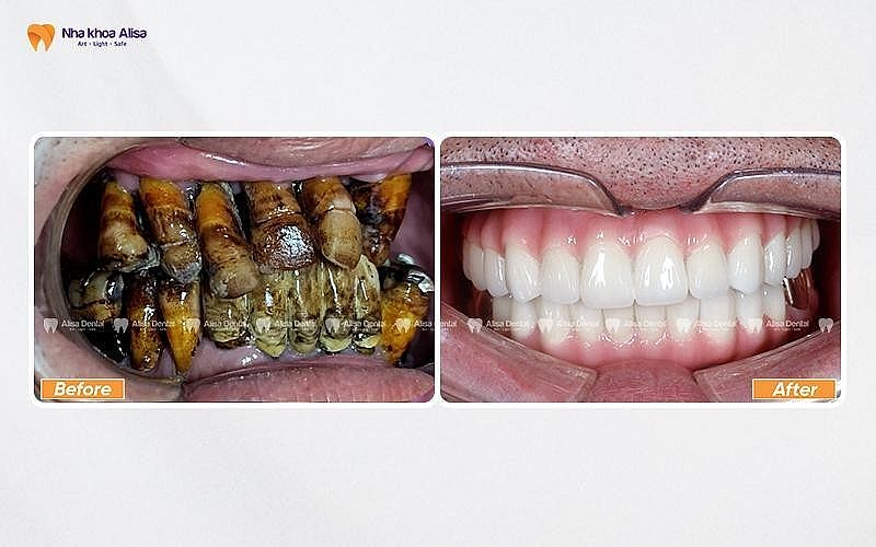 BS Nguyễn Văn Vững (Nha khoa Alisa): Theo đuổi giải pháp ưu tiên bảo tồn răng thật BS Nguyễn Văn Vững (Nha khoa Alisa): Theo đuổi giải pháp ưu tiên bảo tồn răng thật