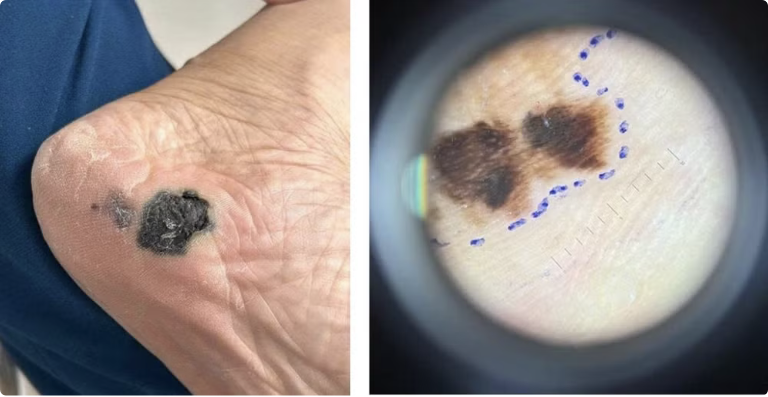 Hình ảnh ung thư tế bào hắc tố trên Dermoscope: màu sắc không đều, bất đối xứng. (Ảnh: Bác sĩ cung cấp) Hình ảnh ung thư tế bào hắc tố trên Dermoscope: màu sắc không đều, bất đối xứng. (Ảnh: Bác sĩ cung cấp)