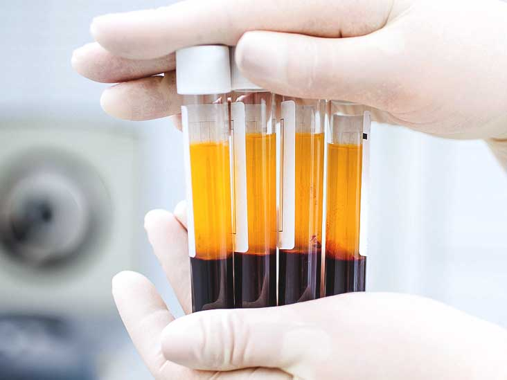 PRP trong điều trị thoái hóa khớp gối: Góc nhìn từ chuyên gia tại MSC Clinic PRP trong điều trị thoái hóa khớp gối: Góc nhìn từ chuyên gia tại MSC Clinic