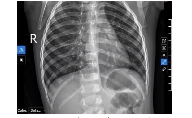 Trẻ mắc RSV, cúm mùa gia tăng khi giao mùa: Cảnh giác dấu hiệu suy hô hấp Trẻ mắc RSV, cúm mùa gia tăng khi giao mùa: Cảnh giác dấu hiệu suy hô hấp
