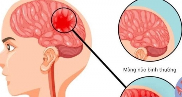 Bệnh não mô cầu có thể gây tử vong nhanh, chuyên gia cảnh báo những dấu hiệu nguy hiểm