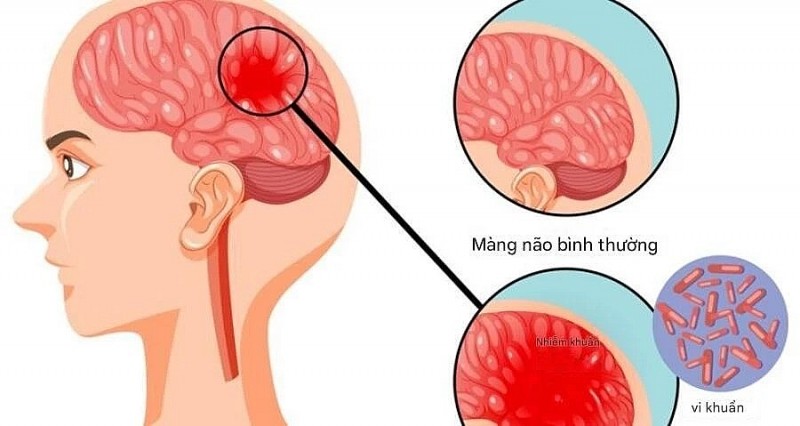 Bệnh não mô cầu có thể gây tử vong nhanh, chuyên gia cảnh báo những dấu hiệu nguy hiểm Bệnh não mô cầu có thể gây tử vong nhanh, chuyên gia cảnh báo những dấu hiệu nguy hiểm
