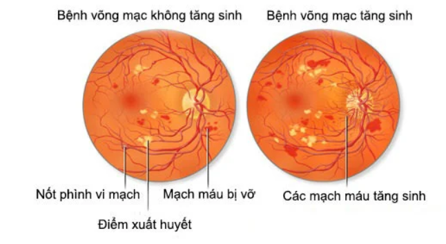 Chăm Sóc Mắt Trong Quản Lý Bệnh Không Lây Nhiễm Ở Người Cao Tuổi Chăm Sóc Mắt Trong Quản Lý Bệnh Không Lây Nhiễm Ở Người Cao Tuổi