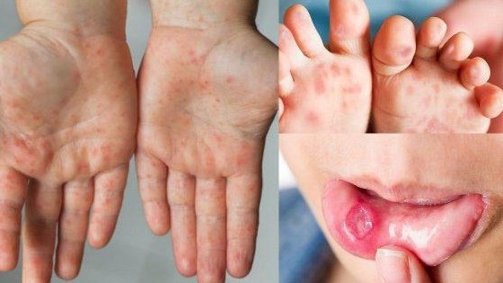 Cảnh báo bệnh tay chân miệng và sốt xuất huyết tiếp tục gia tăng, nhiều ca nặng