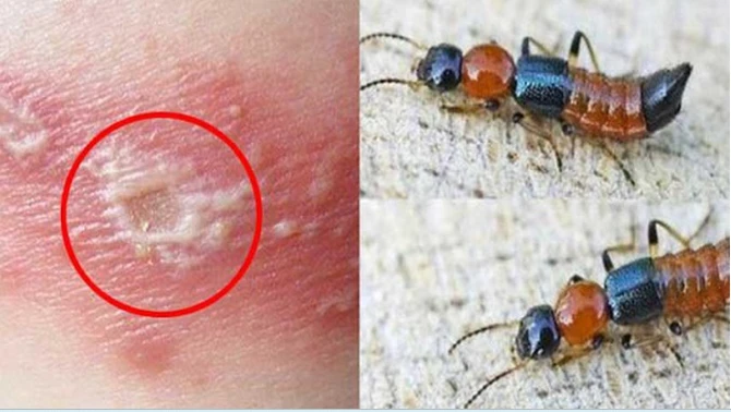 Cách phân biệt kiến ba khoang và zona thần kinh, tránh điều trị sai gây biến chứng