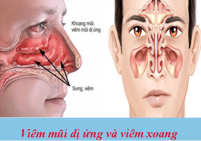 Nghẹt mũi mùa hè: Cảnh giác nhầm lẫn giữa dị ứng và viêm xoang