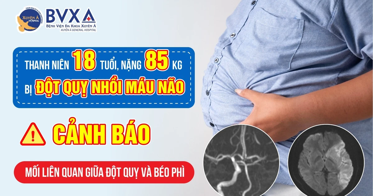 Đột quỵ không còn là bệnh của người già Đột quỵ không còn là bệnh của người già