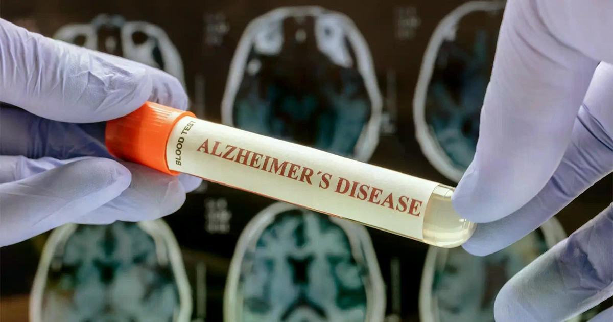 Phát hiện khoa học mới mở ra hy vọng kiểm soát bệnh Alzheimer Phát hiện khoa học mới mở ra hy vọng kiểm soát bệnh Alzheimer