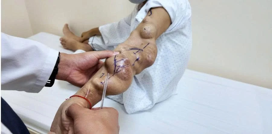Bảo tồn thành công cầu nối AVF sau 11 năm cho người bệnh chạy thận có nhiều túi phình khổng lồ