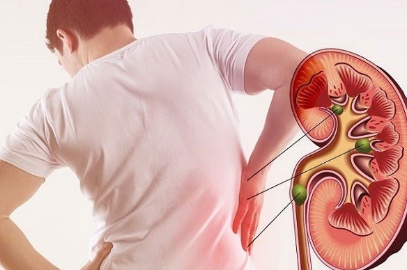Gút không chỉ gây đau khớp: Những biến chứng ít người ngờ tới