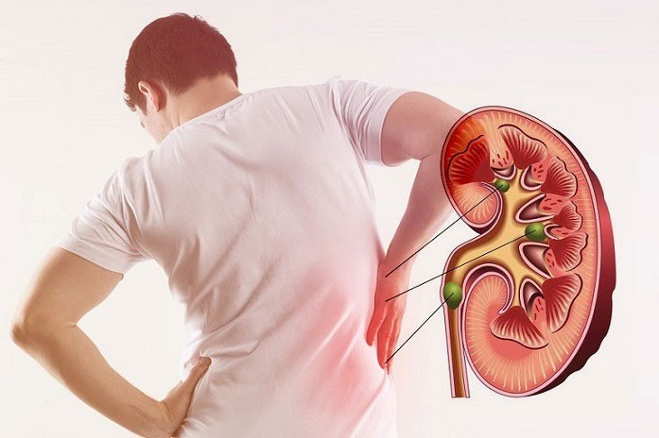 Gút không chỉ gây đau khớp: Những biến chứng ít người ngờ tới
