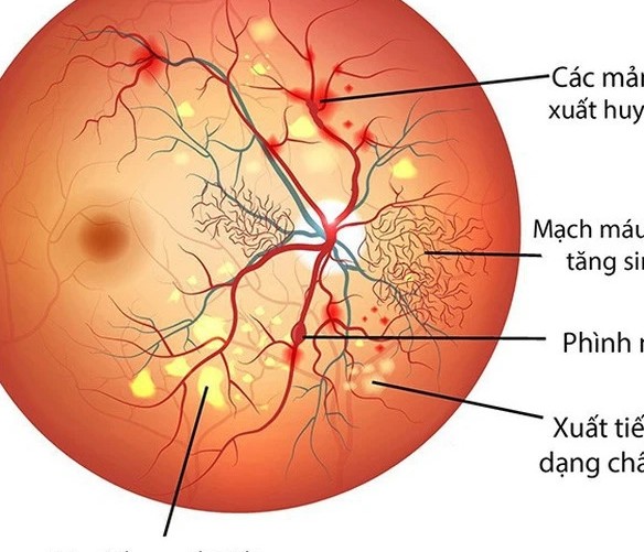 Đái tháo đường - "Kẻ cướp ánh sáng" thầm lặng gây mù lòa