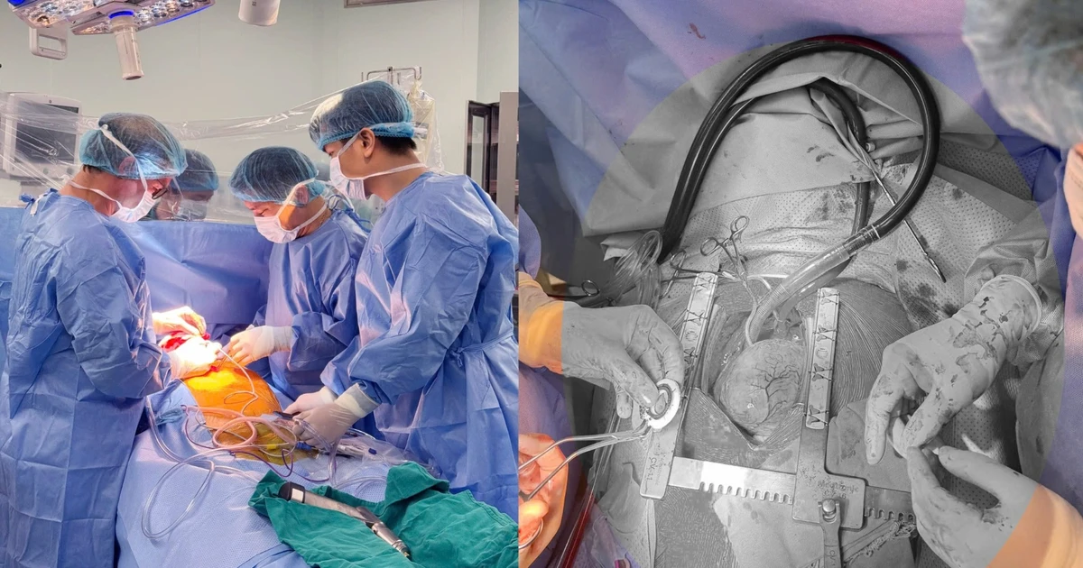 Lần đầu tiên tại Việt Nam cấy ghép thành công thiết bị hỗ trợ tim CorHeart 6