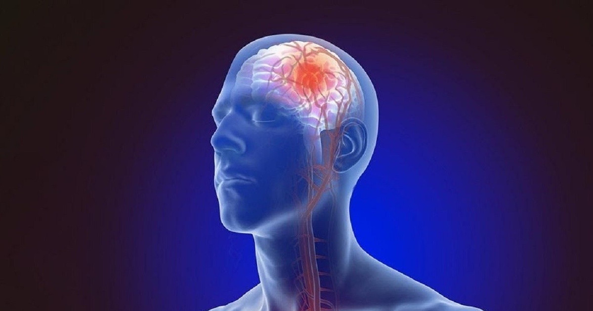 Sau tai biến mạch máu não, làm gì để phục hồi và phòng tái phát? Sau tai biến mạch máu não, làm gì để phục hồi và phòng tái phát?