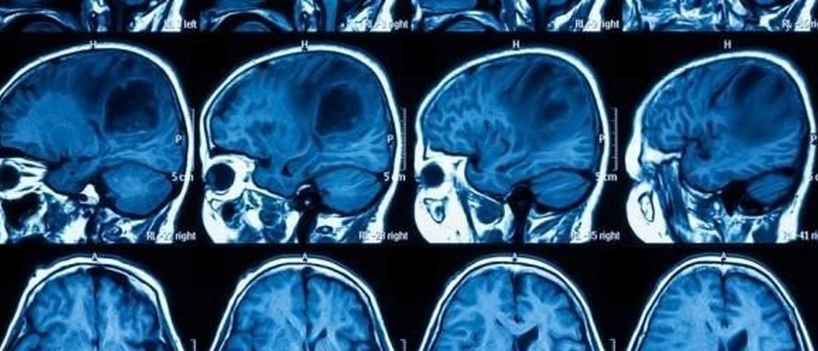 Triển vọng mới cho phương pháp điều trị ưng thư não