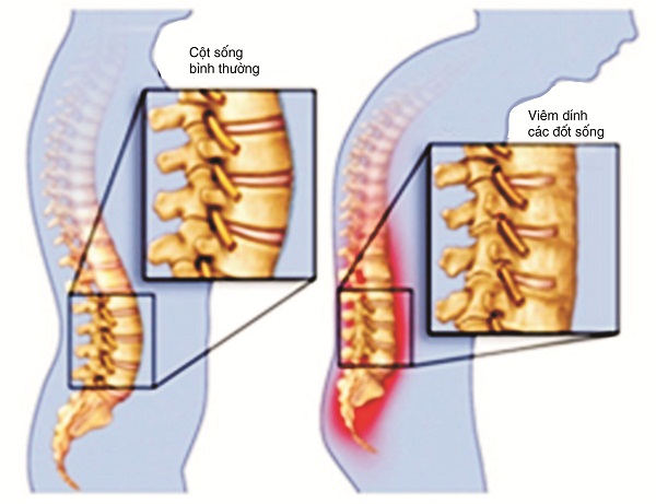 Lưu ý khi điều trị viêm cột sống dính khớp - Ảnh 1.