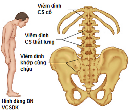 Lưu ý khi điều trị viêm cột sống dính khớp - Ảnh 3.