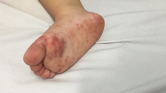 Làm sao sớm nhận biết trẻ mắc tay chân miệng độ nặng?
