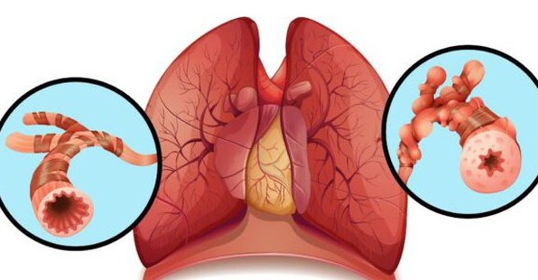 6 câu hỏi thường gặp về bệnh giãn phế quản