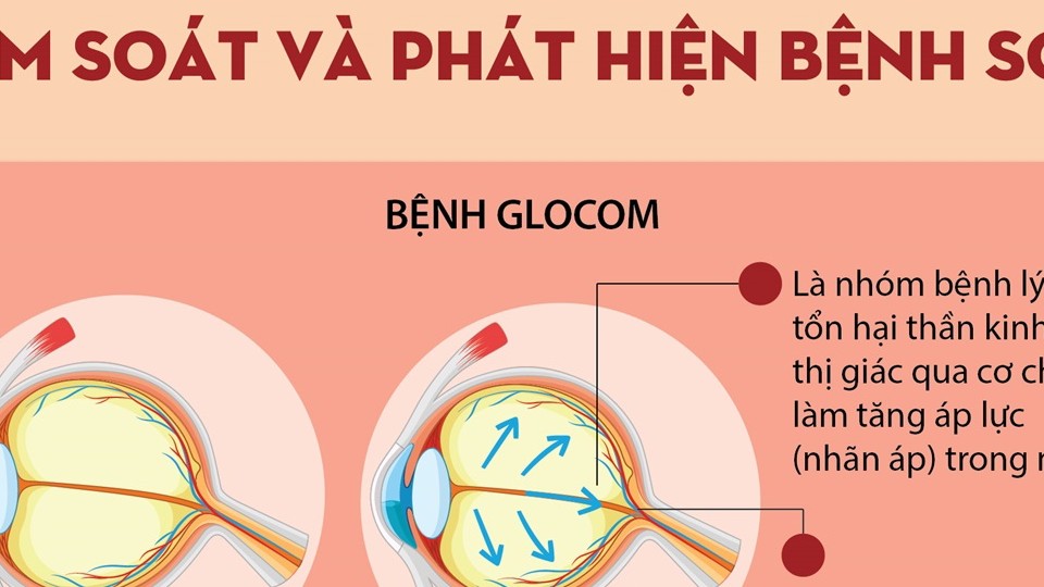 Tuần lễ Glocom Thế giới 2023 (12 - 18/3): Tầm soát và phát hiện bệnh sớm