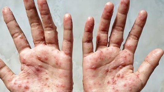 Hàn Quốc nâng mức cảnh báo bệnh đậu mùa khỉ