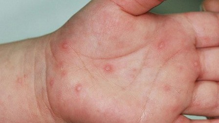 Đã xác định subgenotype của Enterovirus 71 gây bệnh tay chân miệng nặng ở trẻ em