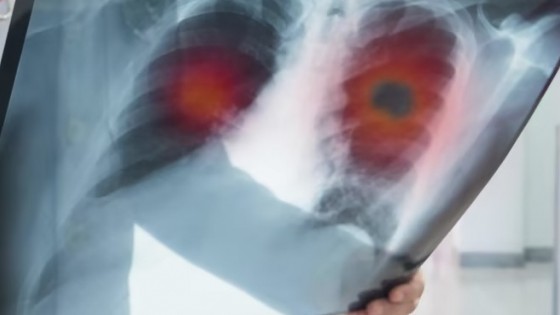 Nghiên cứu: Loại thuốc mới giúp giảm một nửa nguy cơ tử vong do ung thư phổi