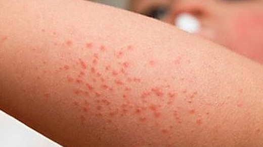 Sốt xuất huyết "vào mùa" sớm