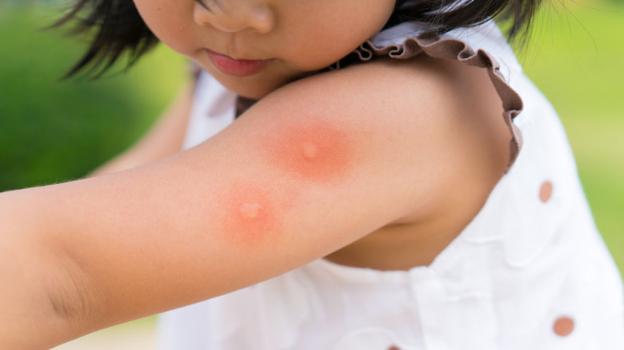 8 biện pháp giảm ngứa, ngăn ngừa nhiễm trùng do muỗi đốt