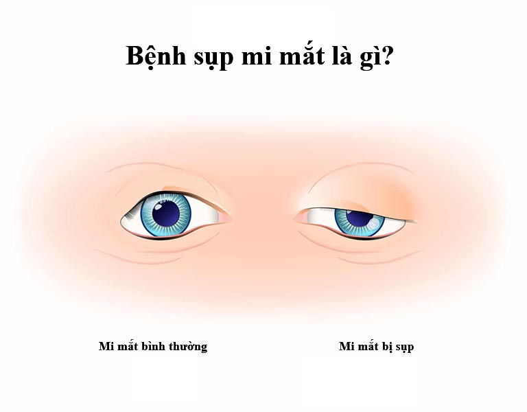 Sụp mí mắt và phương pháp chữa sụp mí mắt bằng Y học cổ truyền