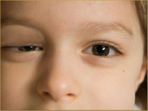Sụp mí mắt và phương pháp chữa sụp mí mắt bằng Y học cổ truyền
