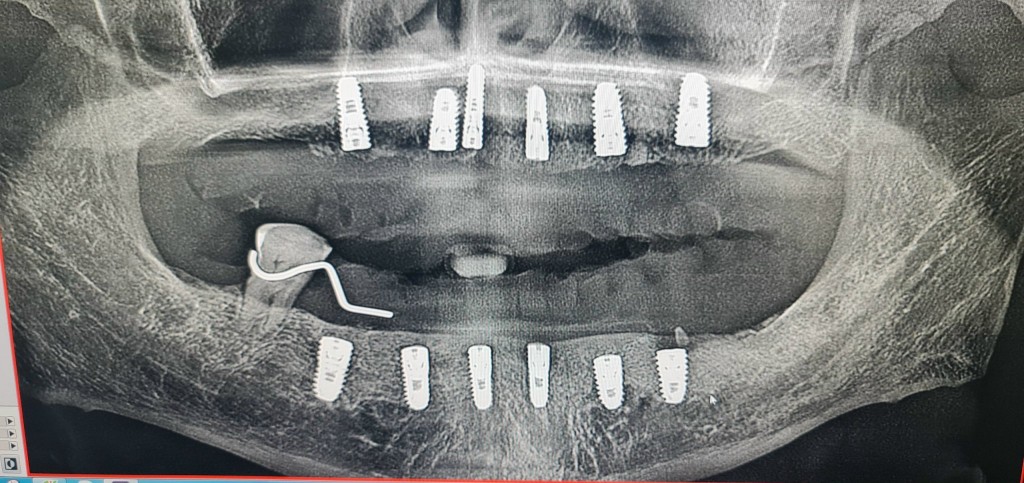 Nha khoa Miley Luxury đối mặt với các cáo buộc về việc cấy ghép Implant răng không được chứng nhận