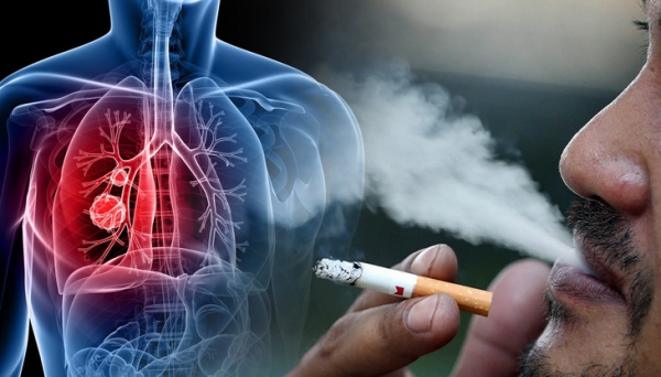 Tỷ lệ mắc mới ung thư phổi có xu hướng gia tăng