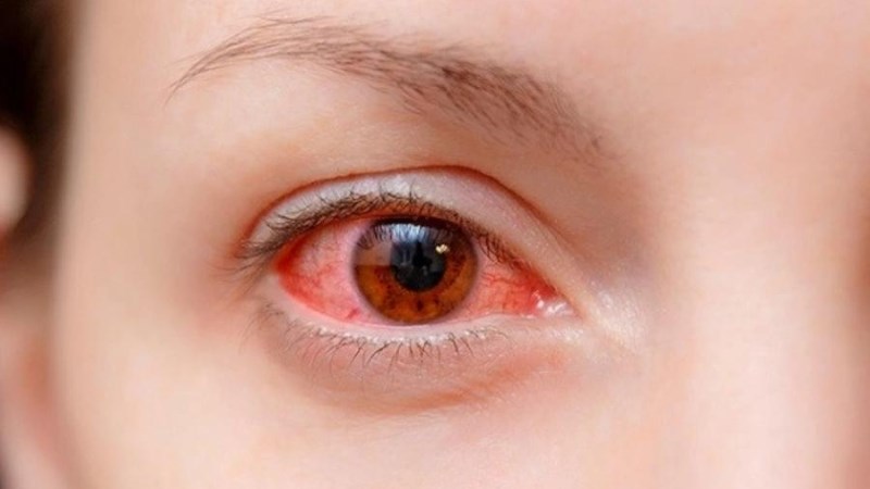 Bài thuốc nam giúp phòng và điều trị đau mắt đỏ