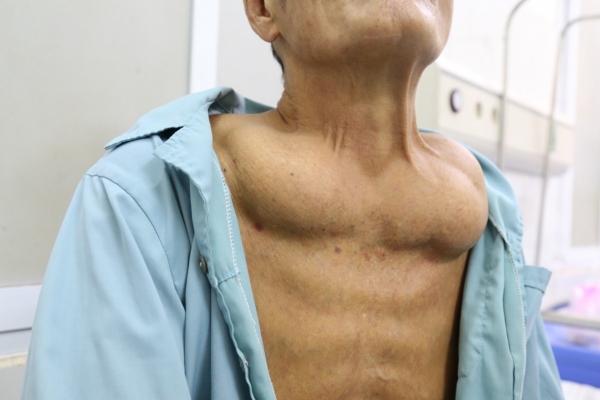 Bệnh Madelung: Triệu chứng, nguyên nhân và cách điều trị