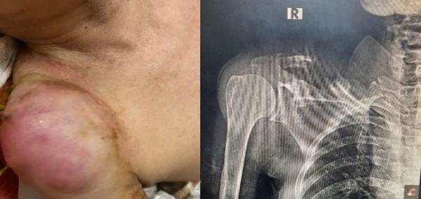 Cảnh báo biến chứng nặng do sử dụng thuốc nam không đúng cách