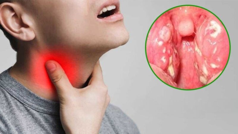 Phân biệt bệnh bạch hầu và viêm họng