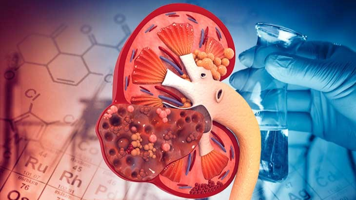 Những thói quen gây suy thận ở người trẻ